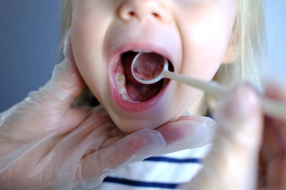 kids dental fillings